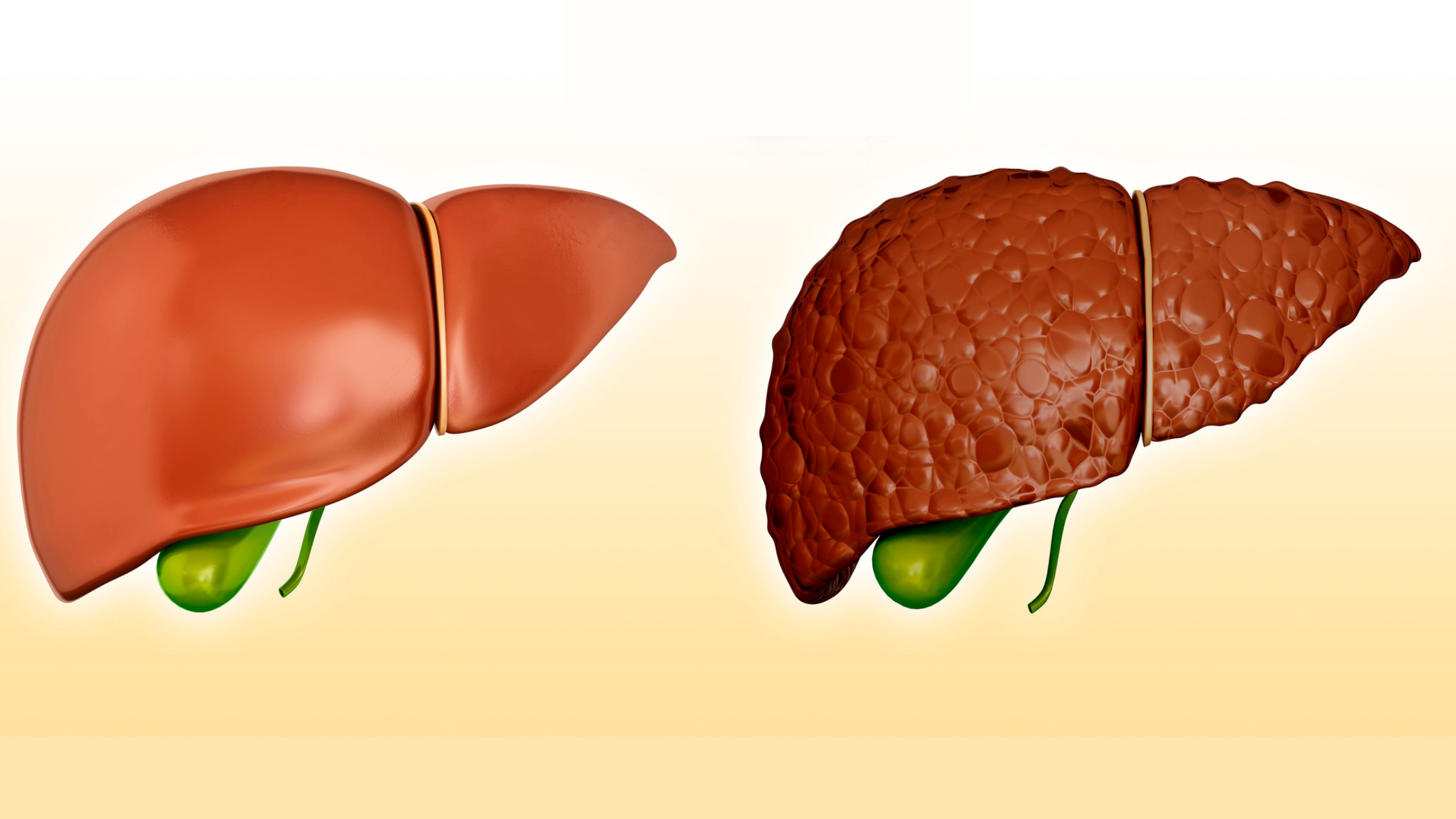 what-you-need-to-know-about-cirrhosis-for-the-nclex-exam-free-download